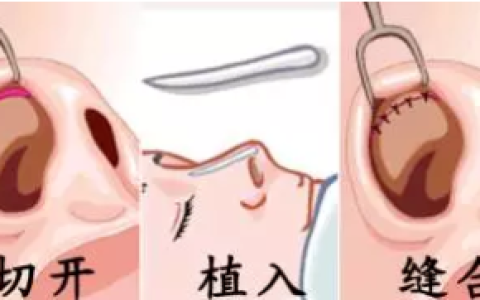 假体隆鼻低头会怎么样，自体软骨隆鼻手术的注意事项有哪些