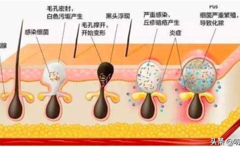 怎么样治疗青春痘，青春痘怎么治疗最好中学生