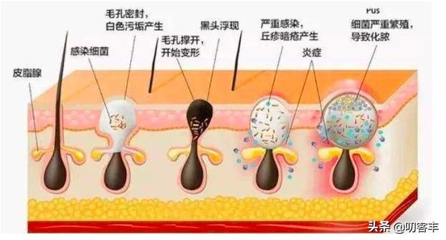 青春痘怎么治？
