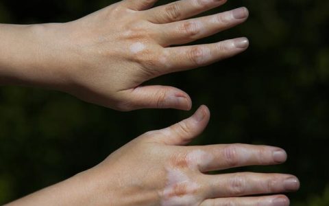 怎么样控制白斑，如何护理才能阻止白斑扩散呢