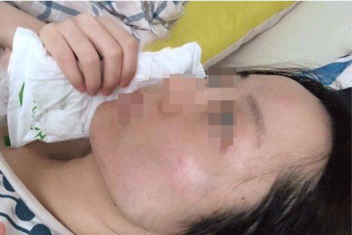 妈妈想去做个全脸线雕，有点担心 做过的给一些真实的建议