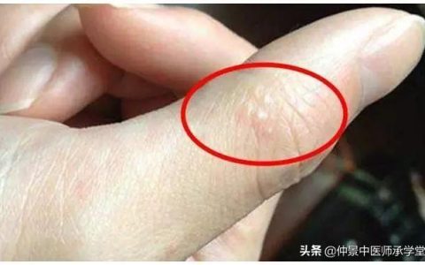 戒之馆化湿精油怎么样，手足癣久治不愈,可以用温阳化湿法治疗吗