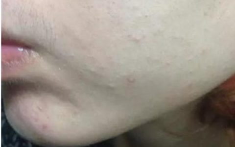 怎么样才能消去青春痘，消除脸上痘痘