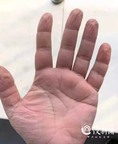 压伤、消毒手、足发白……  @医护人员，抗疫期间皮肤问题药方请查收