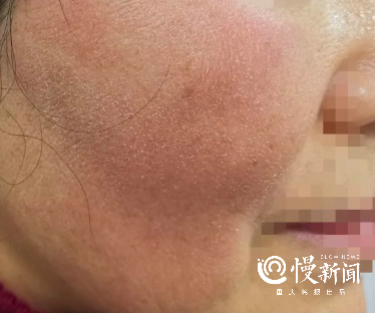 压伤、消毒手、足发白……  @医护人员，抗疫期间皮肤问题药方请查收