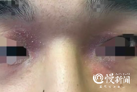 压伤、消毒手、足发白……  @医护人员，抗疫期间皮肤问题药方请查收