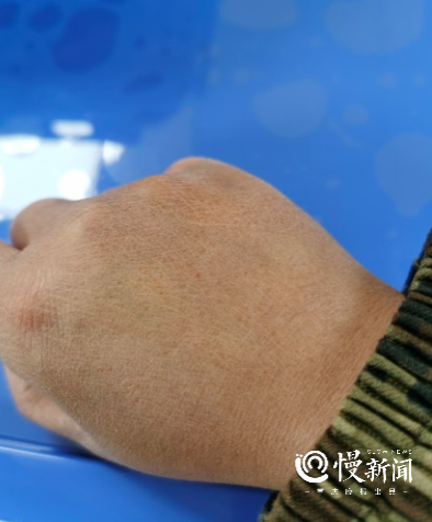 压伤、消毒手、足发白……  @医护人员，抗疫期间皮肤问题药方请查收