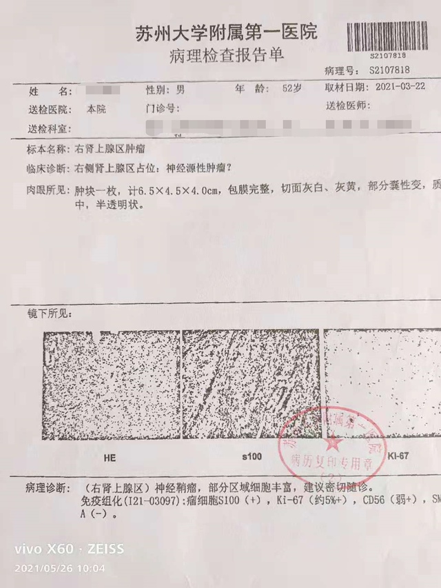 患者花5万切瘤后不理赔，太平洋保险：良性肿瘤不在保障范围
