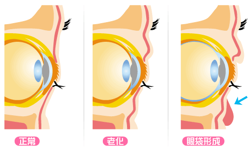 想祛眼袋，医生说有这3种方法